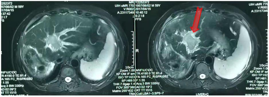 放疗肝内胆管细胞癌能治好吗,放疗治疗肝门静脉癌栓