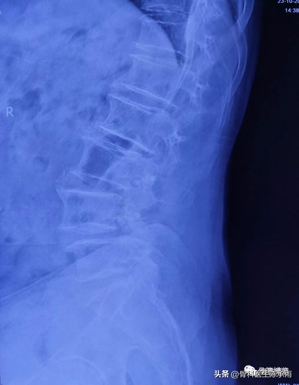 腰椎滑脱椎管狭窄手术后遗症,腰椎间盘突出椎管狭窄的手术