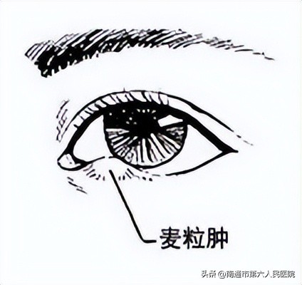 “偷针眼”？你还在用头发丝或棕丝这种土方子吗？