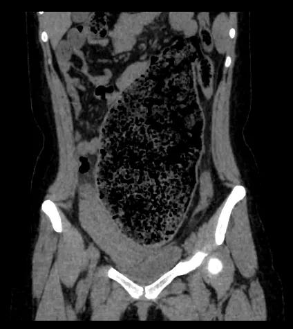 便便从阴道里出来？20多岁的她面临的问题不止如此……