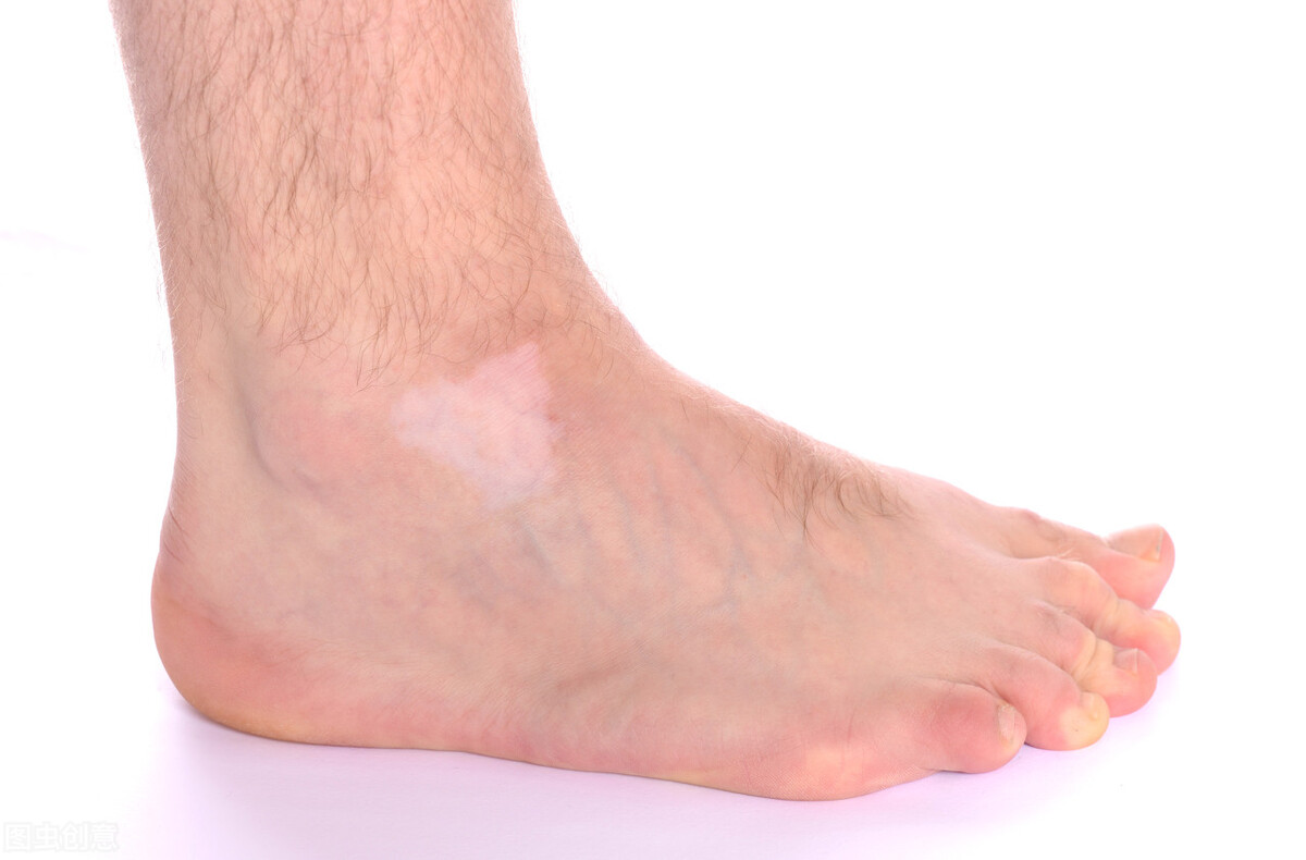 用什么方法治疗脚部白癜风最有效,脚部白癜风该怎么治疗好