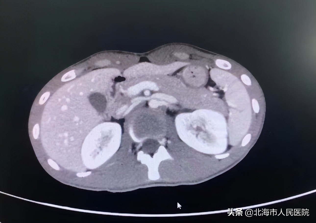 一名男子骑摩托车事故右腿骨折,男子骑摩托车摔成骨折