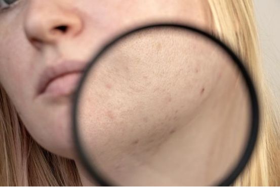 有斑点怎么办,有斑点用什么淡化