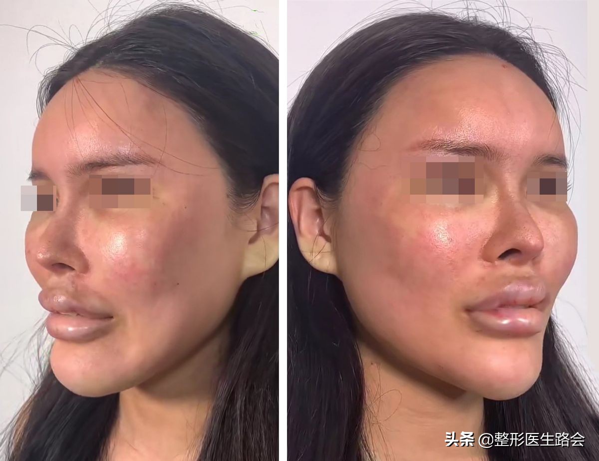 玻尿酸全脸填充年轻化,全脸玻尿酸填充真的会好看吗