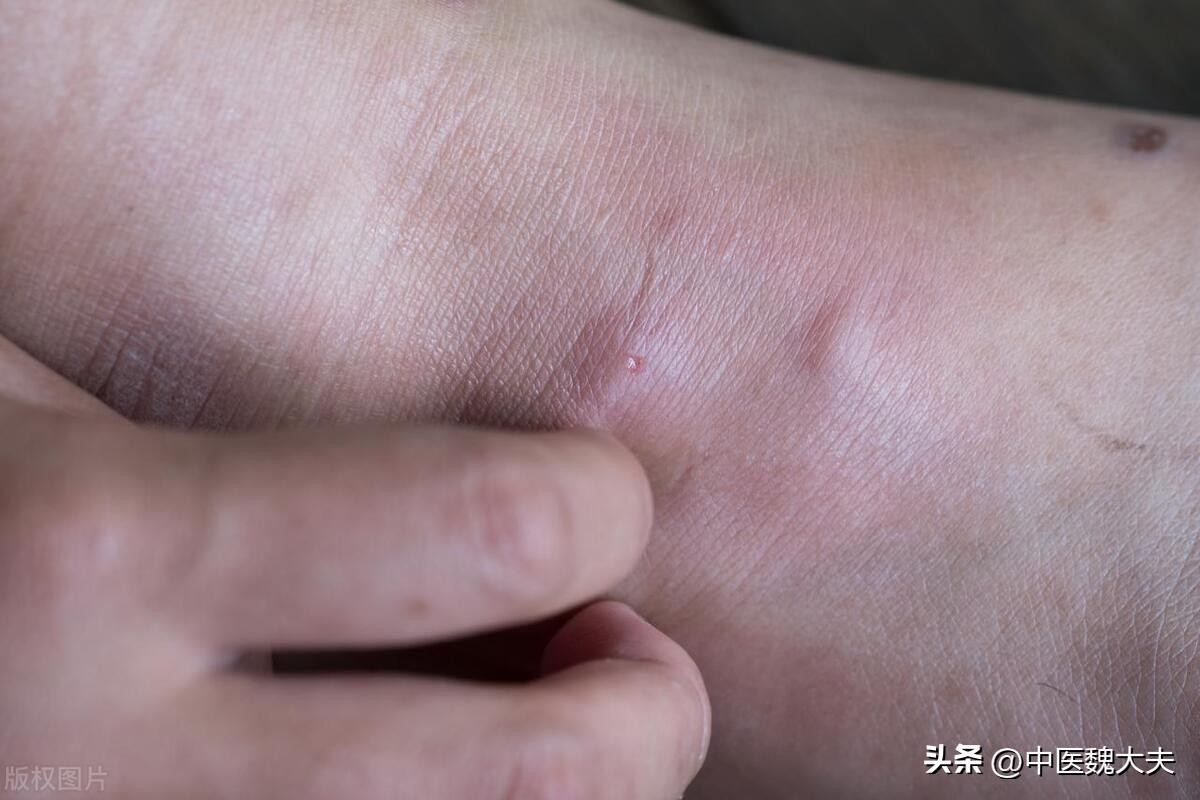 糖尿病患者身上出现7种情况,糖尿病出现五种并发症能活多久