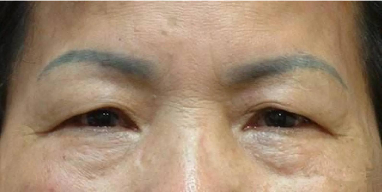 才19岁脸上就起皱纹了是缺什么,19岁就有很重的眼角细纹了