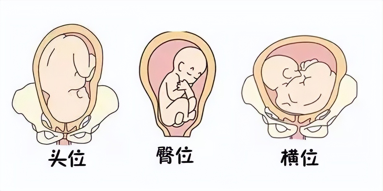 头胎顺产二胎胎位,二胎妈妈宫缩难产生孩子