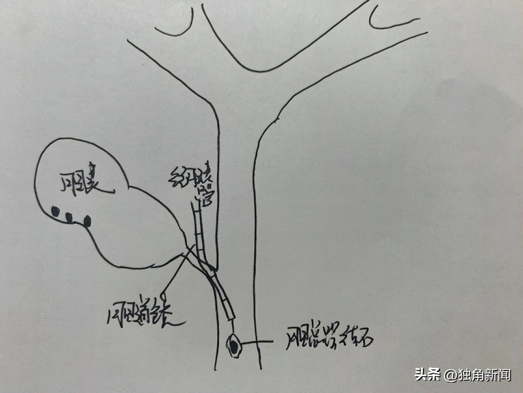 胆道微创,胆结石微创手术三个孔