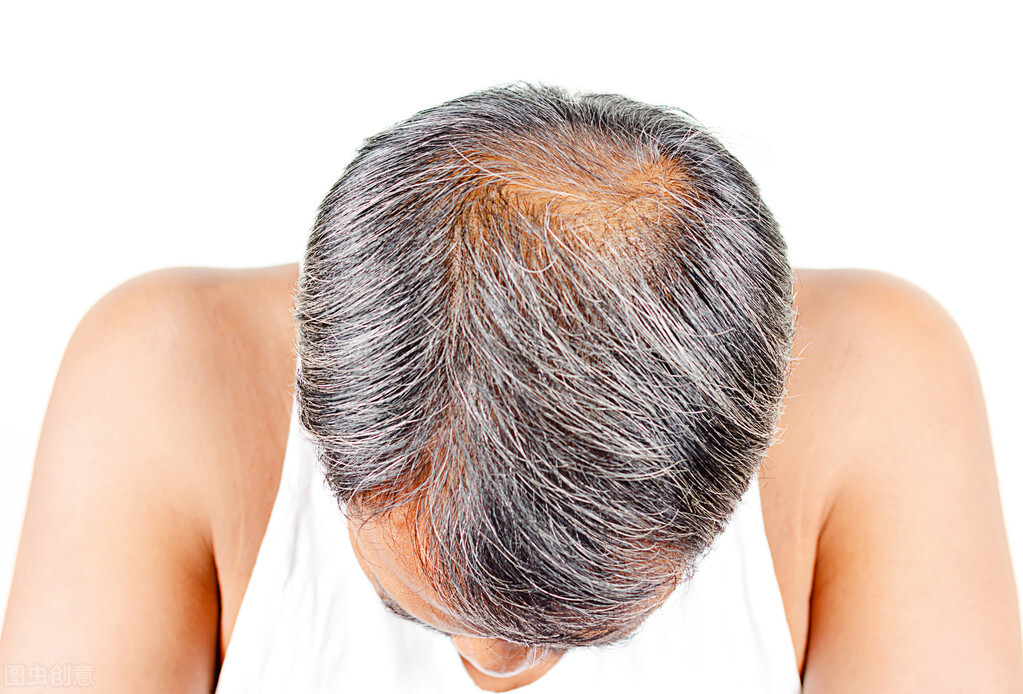 中医说头发出油多但不掉发,头发出油掉发中医辨证