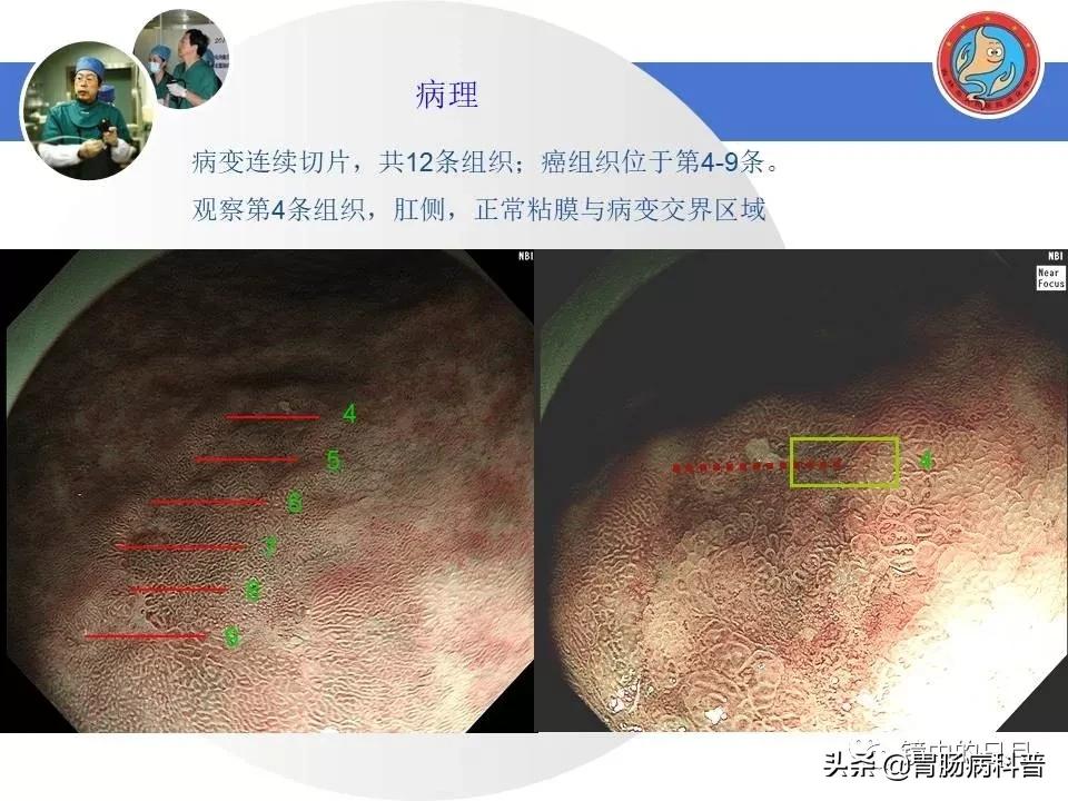 胃癌可以做内镜手术吗,早期胃癌内镜手术后追加外科手术