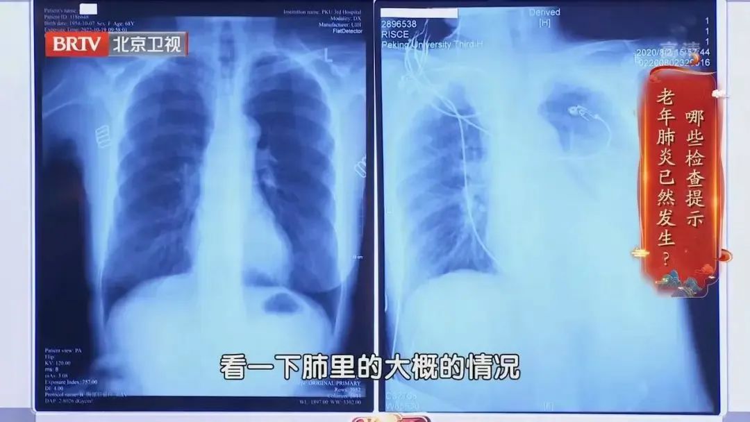 预防肺炎吃什么食物最好,老年肺炎宜吃什么食物