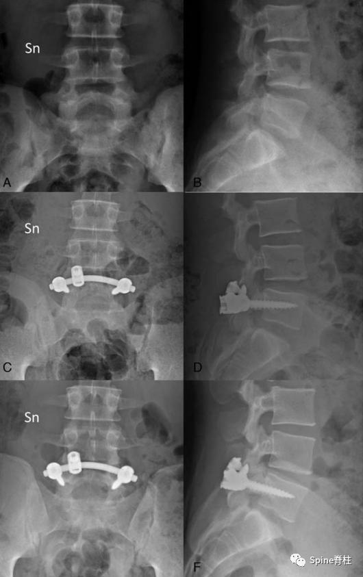 峡部裂和隐性峡部裂有区别吗,单纯峡部裂可以做峡部修复吗