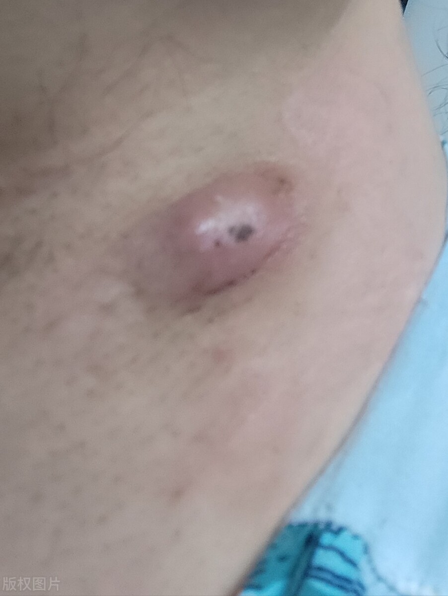 脖子上的小肉球千万别去用手拽,脖颈上的小肉球怎么办