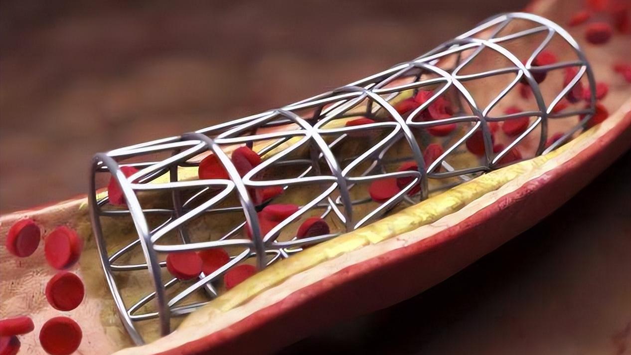 心脏支架手术做了还会堵,还有必要做吗?做与不做取决于这一点