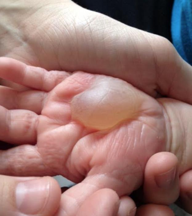 烫伤的紧急处理方法,烫伤紧急处理的第一步是