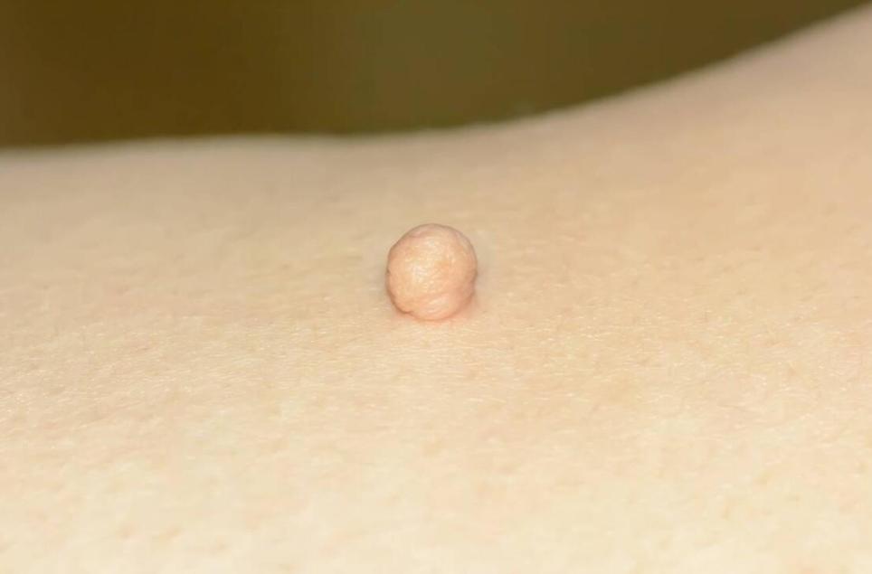 脖子上的小肉粒揪下去会变多吗,脖子腋下长小肉粒可以用手揪掉吗