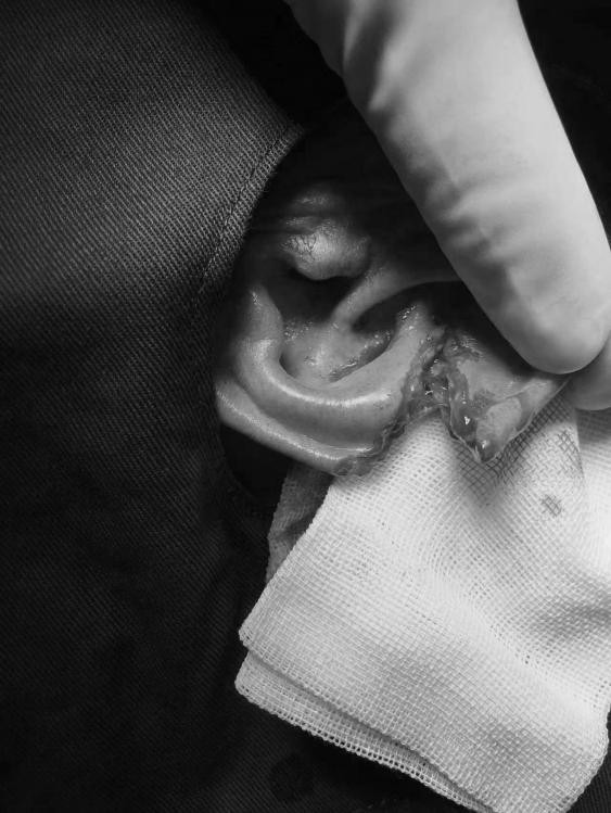 耳廓撕裂伤疤痕怎么处理,耳廓软骨断裂缝合技巧