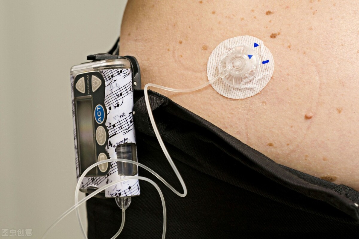 二型糖尿病适合戴胰岛素泵吗,初发糖尿病住院用胰岛素泵多久