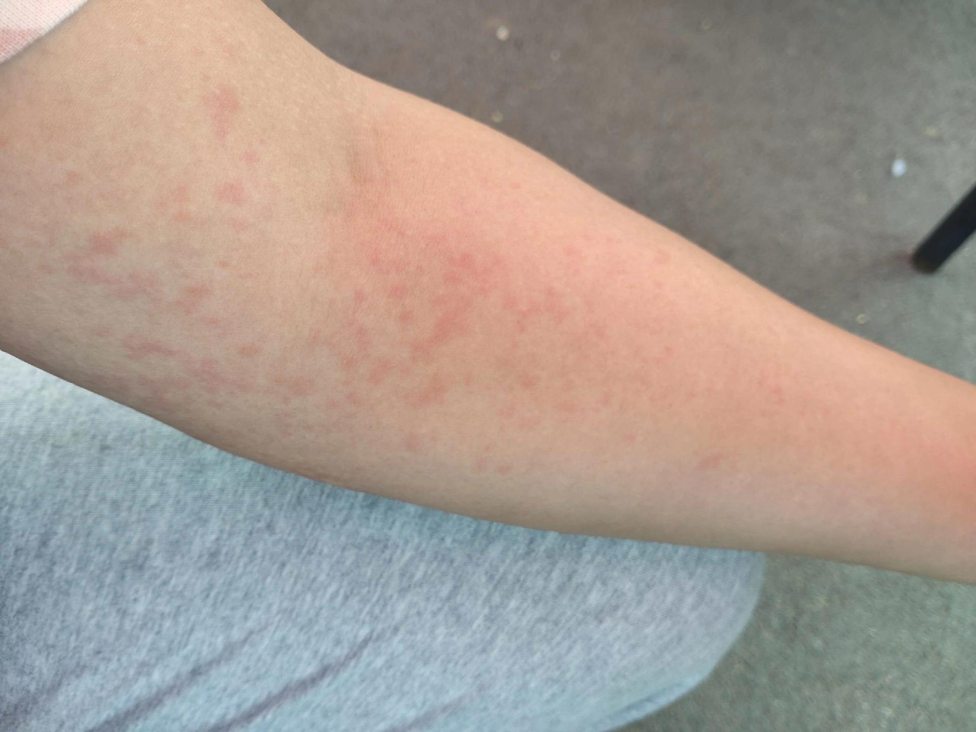 麻疹高发季怎么防控,荨麻疹换季导致全身发痒