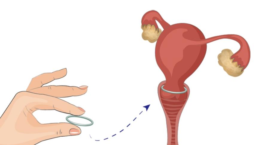 老年女性体内的节育环还用取掉吗,体内节育环几年要取掉