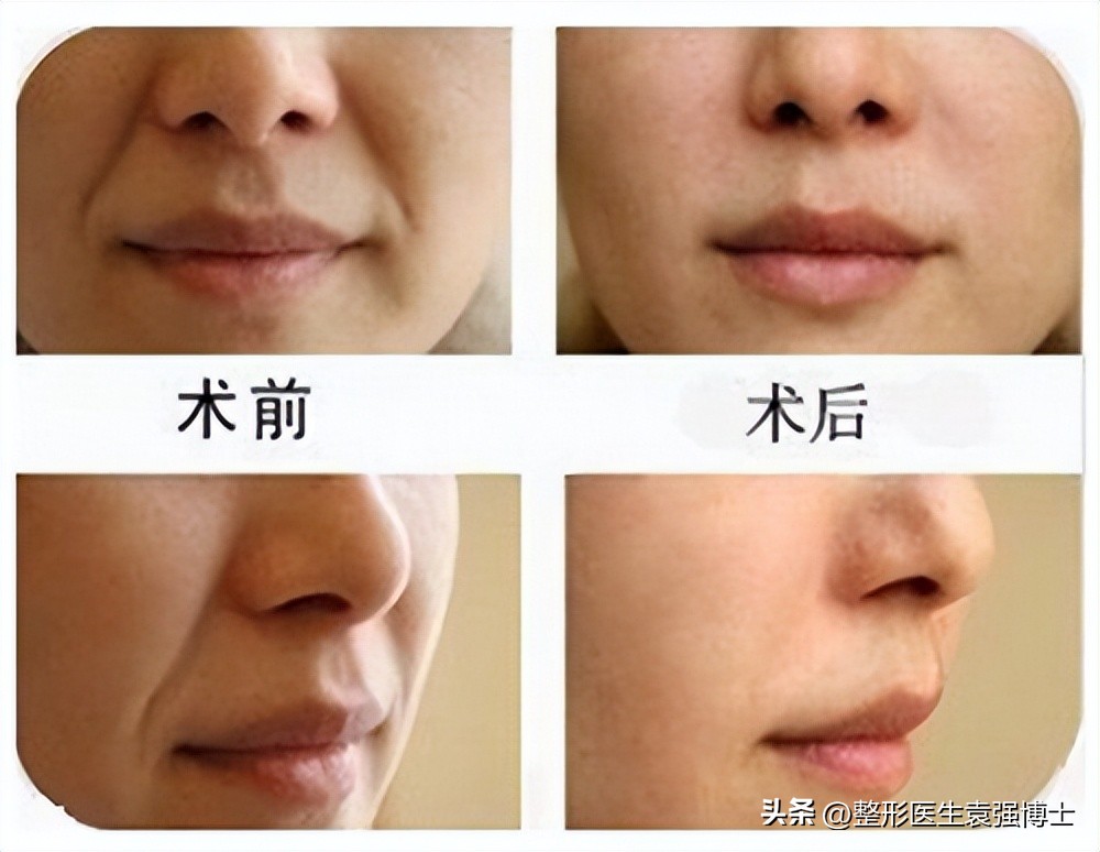 法令纹难解决,法令纹好严重怎么办