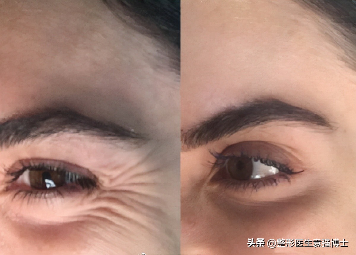 面部提升除皱手术效果过程解析,目前面部除皱最安全有效的方法