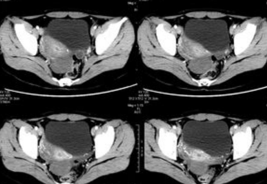 女性妇科疾病的10个征兆,妇科检查发现病变什么意思