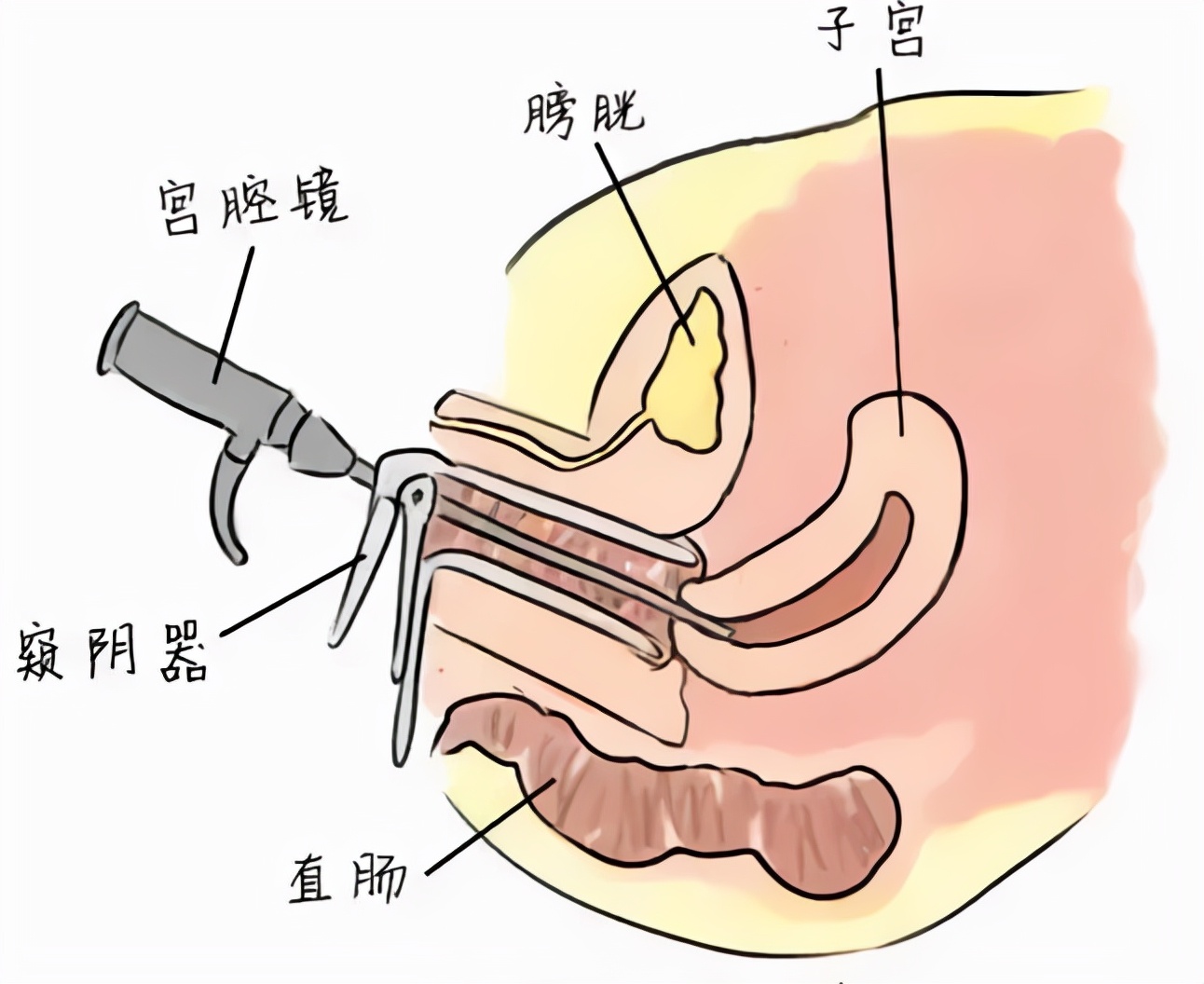 「疾病科普」宫腔粘连的治疗
