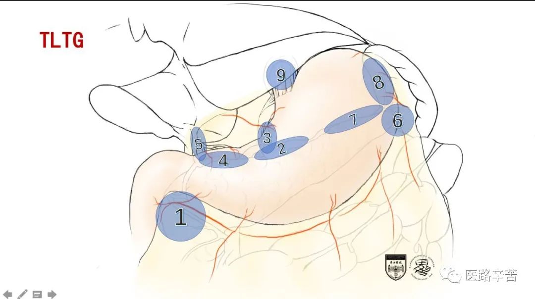全腹腔镜胃癌根治术，学习大咖怎么清扫淋巴结