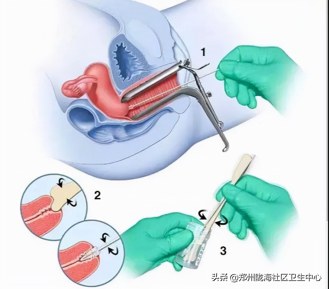 我的头上有青青草原,女友查出感染hpv