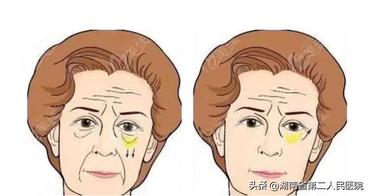 眼睛下面长了个小疙瘩可以切掉吗,眼睛长了个凸起的小包用手术吗