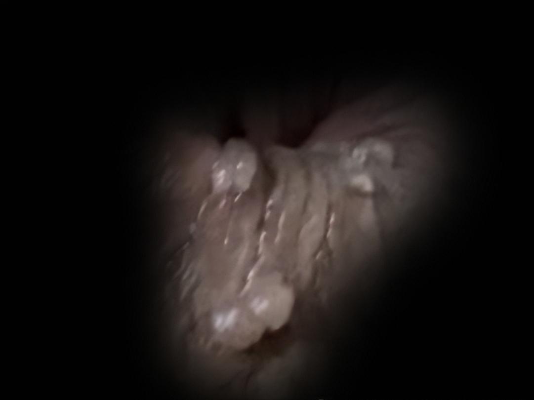 尖锐性湿疣效果最好的治疗方案,尖锐性湿疣治疗最省钱的方法