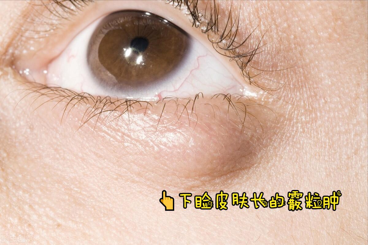 眼皮长了个小疙瘩怎么去掉,右眼皮上长了个小疙瘩预兆