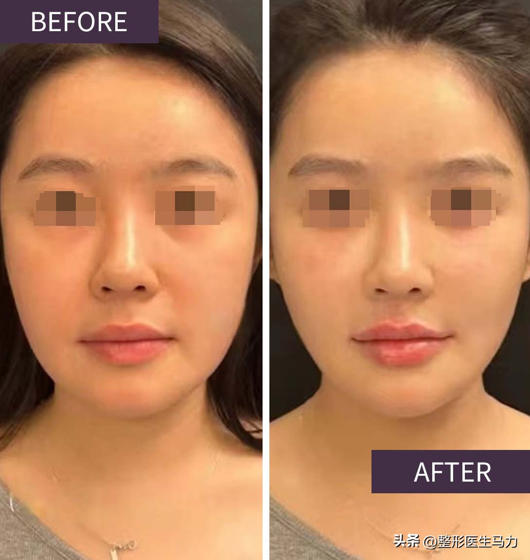 打了玻尿酸多久可以打肉毒,玻尿酸注射痛还是肉毒痛