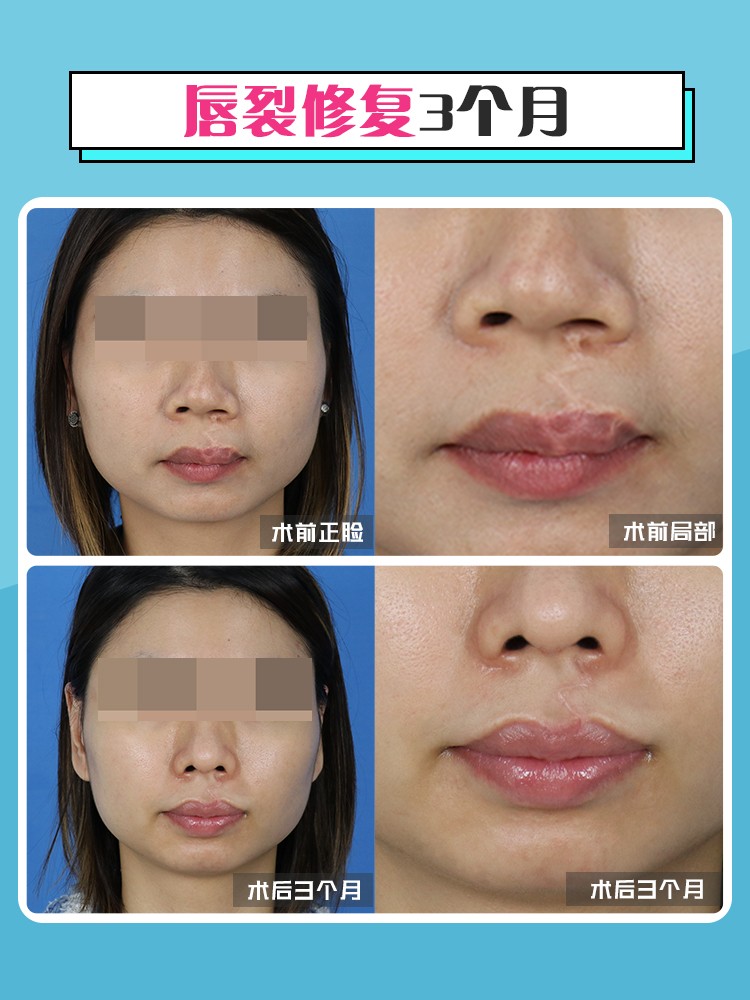 唇裂手术疤痕修复手术大概多少钱,唇裂手术后1个月后涂什么疤痕膏