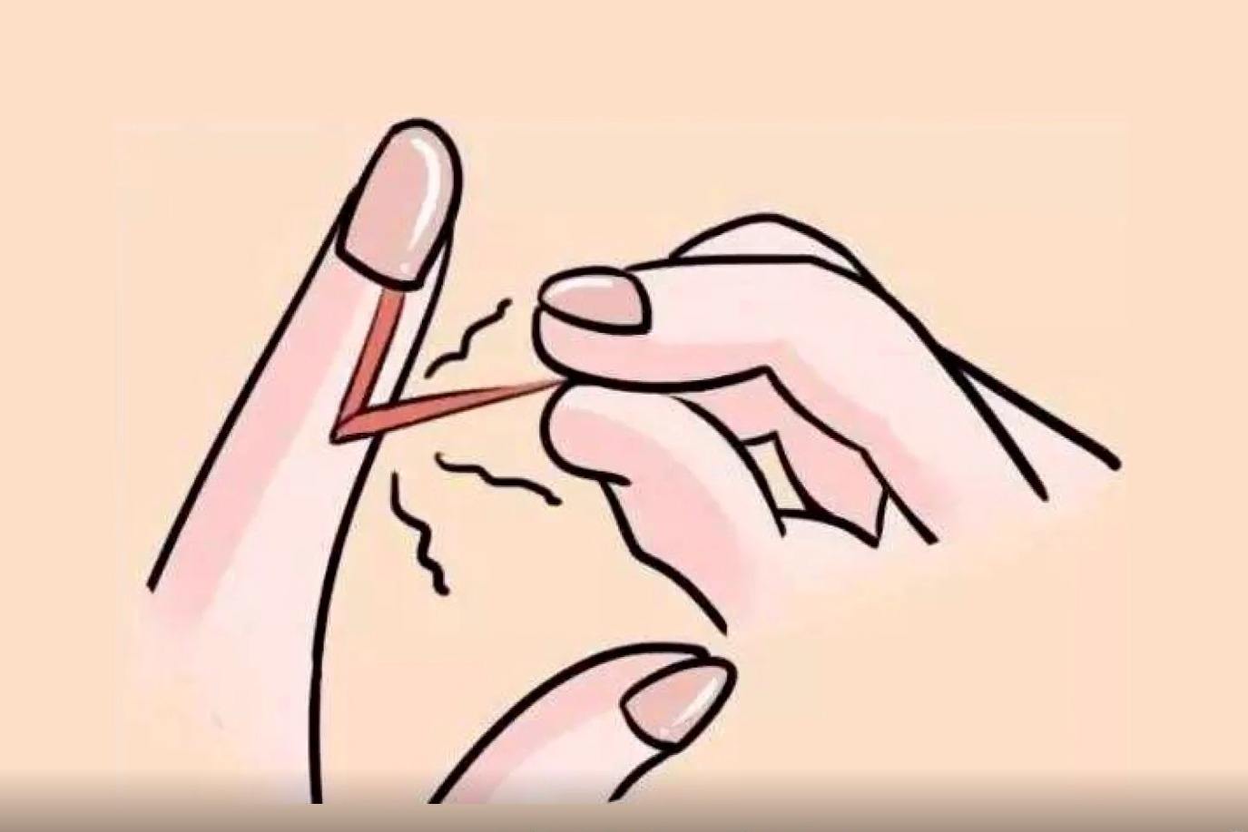 手上的倒刺怎么去除最快方法,手上长倒刺能剪掉吗