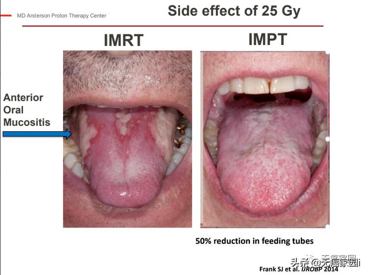 头等大事严防严控,硼中子俘获疗法能彻底治愈癌症吗