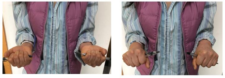 治疗骨折新技术,微创手术治疗骨折的方法