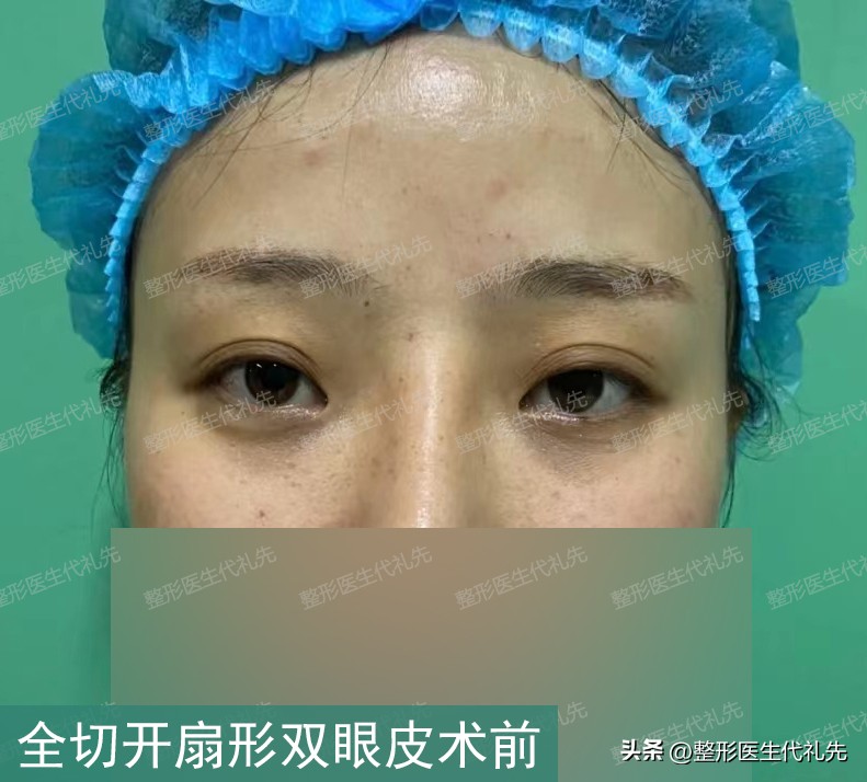 43岁女士全切开扇形双眼皮,术前术后高清照片细节对比,变化很大