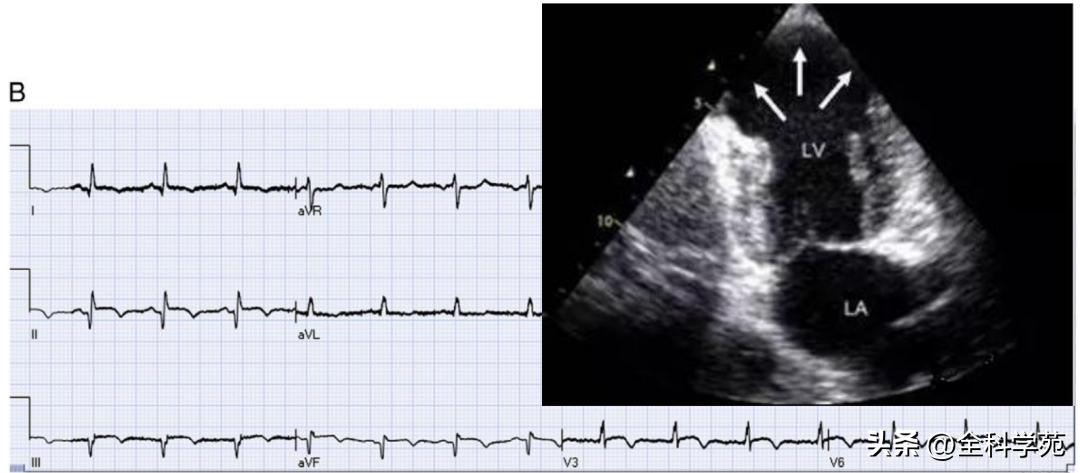 t波倒置三种常见原因,t波低平倒置有事吗