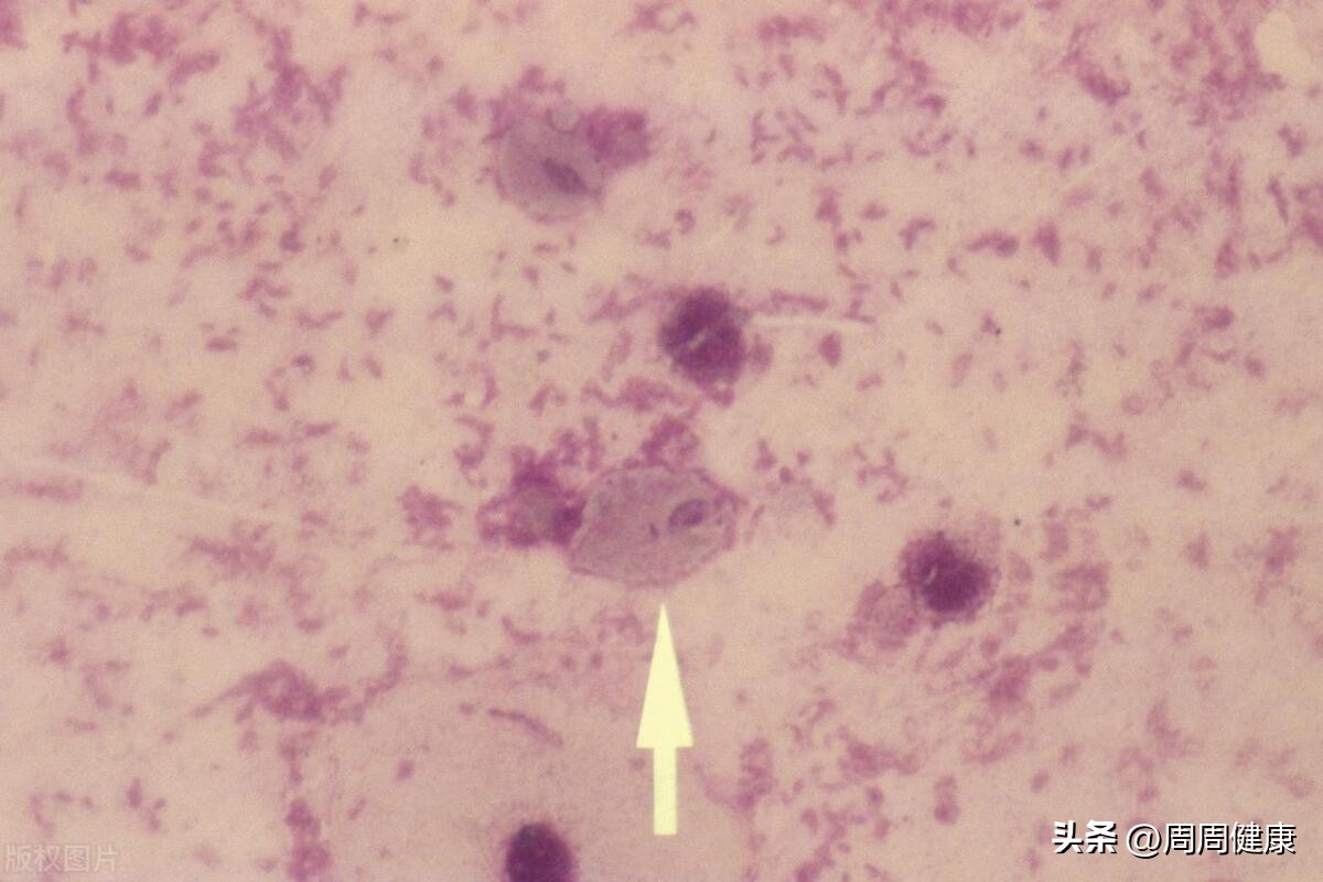 阴道炎症状表现,阴道炎能自愈吗