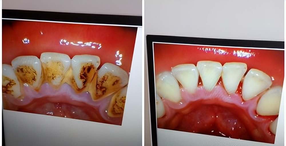 美白牙粉的功效和作用,牙齿美白去黄牙粉使用方法