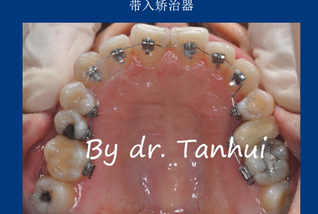 地包天能做手术矫正吗,儿童地包天矫正几岁做最好