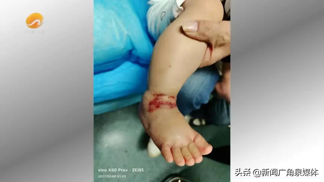 小孩发烧42度导致的死亡事件,4岁小孩突然高烧离世