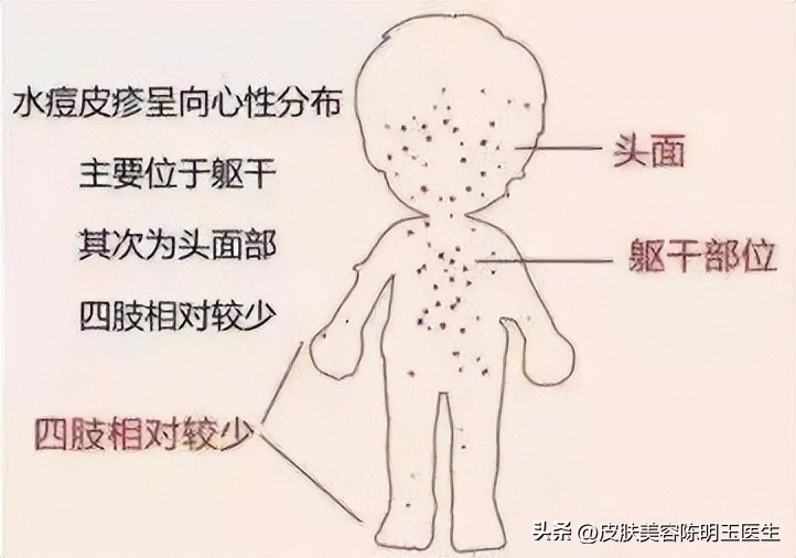 怎么最快的方法治愈水痘,如何判断水痘是轻症还是重症
