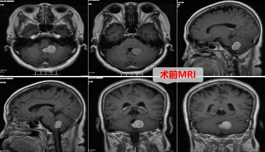 脑梗走路总想往一侧歪,走路总往右侧歪是怎么回事