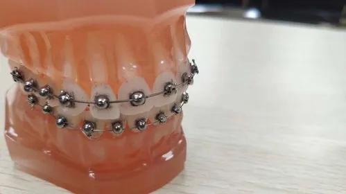 戴牙套必须知道的事,戴牙套前你必须要知道的事