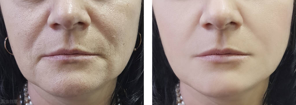 拉皮抗衰老最多能做几次,拉皮和青春定格哪个抗衰老效果好