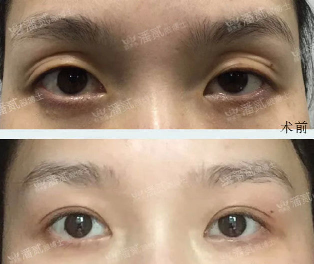 眼窝凹陷是什么症状,眼窝凹陷的改善方法有哪些