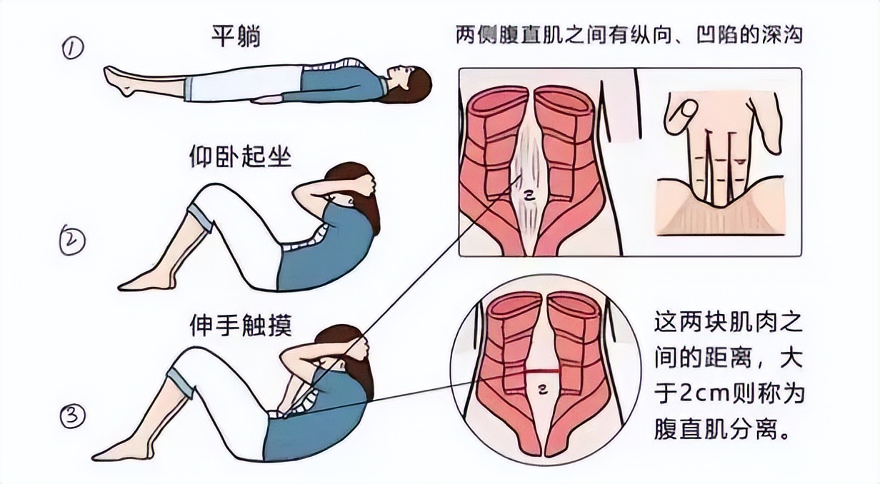 妇幼保健院有腹直肌分离修复吗,市妇幼腹直肌分离修复